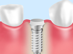 STEP2:人工歯根の埋入