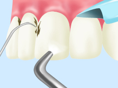 STEP2：歯石除去