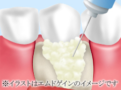 歯周組織再生治療法